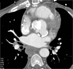 Aortic Valve Replacement (AVR) Repair With Pseudo-aneurysm Off Root - CTisus CT Scan