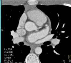 LAD and Circumflex Arise Directly Off the Left Cusp - CTisus CT Scan