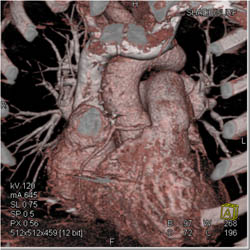 Left Saphenous Bypass Graft - CTisus CT Scan