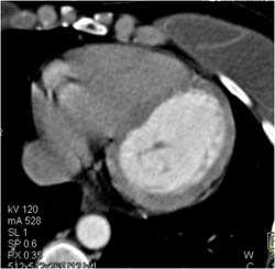 Motion Obscures RCA - CTisus CT Scan