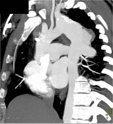 Unusual Repair- in Russia- of Coarctation of the Aorta (COA) With Dissection at Site of Surgery - CTisus CT Scan