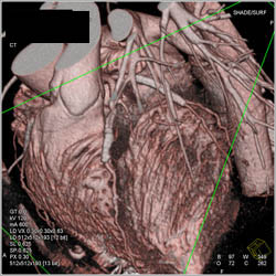 Stent in LAD - CTisus CT Scan