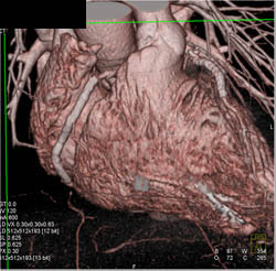 Stent in LAD - CTisus CT Scan