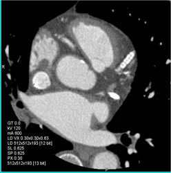 Stent in LAD - CTisus CT Scan