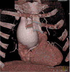 Dilated Aortic Root Due to Aortic Stenosis - CTisus CT Scan