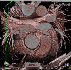 RCA Arises Off Left Cusp - CTisus CT Scan