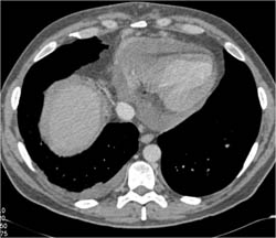 Pericardial Effusion - CTisus CT Scan