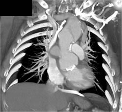 Pseudo-aneurysm Compresses the SVC With Collaterals - CTisus CT Scan