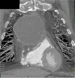 Ascending Aortic Aneurysm Repair With Composite Graft - CTisus CT Scan