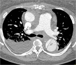 Type B Dissection - CTisus CT Scan