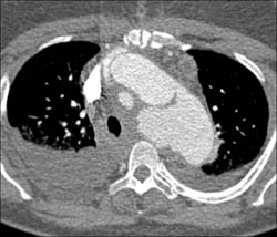 Type B Dissection - CTisus CT Scan