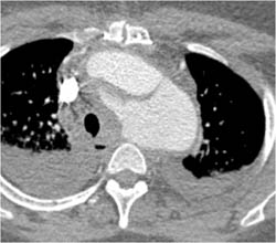 Type B Dissection - CTisus CT Scan