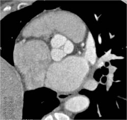 Normal Aortic Valve - CTisus CT Scan