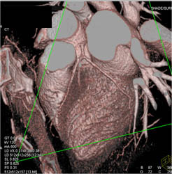 Minimal Plaque in RCA and LAD - CTisus CT Scan