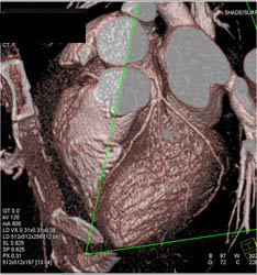 Plaque LAD - CTisus CT Scan