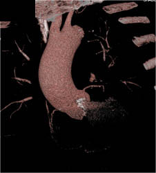 Calcified Aortic Valve With as and Dilated Ascending Aorta - CTisus CT Scan