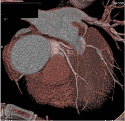 Bicuspid Valve - CTisus CT Scan