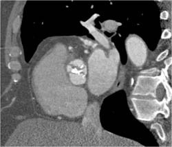 Bicuspid Valve - CTisus CT Scan