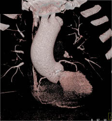 Calcified Aortic Valve - CTisus CT Scan