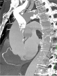 Partially Calcified Arch - CTisus CT Scan