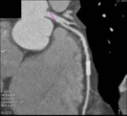 Patent Stent in LAD - CTisus CT Scan