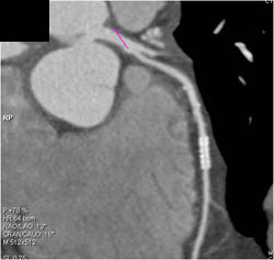 Patent Stent in LAD - CTisus CT Scan