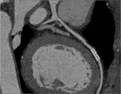 Patent Stent in LAD - CTisus CT Scan