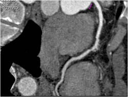 Pseudo Lesion - CTisus CT Scan