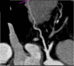 Myocardial Bridging of LAD - CTisus CT Scan