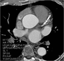 Diseased LAD - CTisus CT Scan