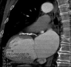 Diseased LAD - CTisus CT Scan