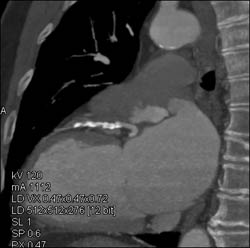 Diseased LAD - CTisus CT Scan