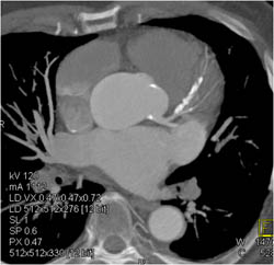 Diseased LAD - CTisus CT Scan