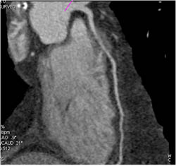 Myocardial Bridging - CTisus CT Scan