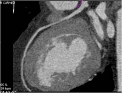 Myocardial Bridging - CTisus CT Scan