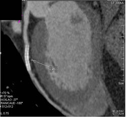 Patent LAD Stent - CTisus CT Scan