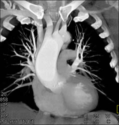 Dilated Ascending Aorta - CTisus CT Scan