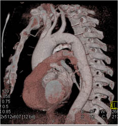 Dilated Ascending Aorta - CTisus CT Scan