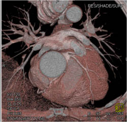 LAD and Circumflex Arise Directly Off Left Cusp - CTisus CT Scan