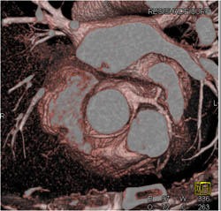 RCA Arises Off Left Cusp - CTisus CT Scan