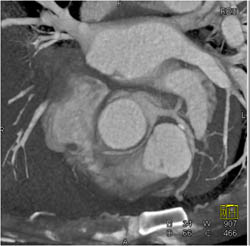 RCA Arises Off Left Cusp - CTisus CT Scan