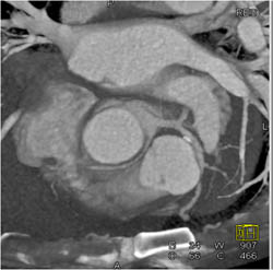 RCA Arises Off Left Cusp - CTisus CT Scan