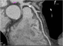 Plaque in LAD - CTisus CT Scan