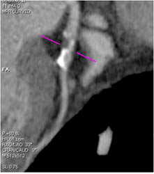 Greater Than 50% Narrowing in LAD - CTisus CT Scan