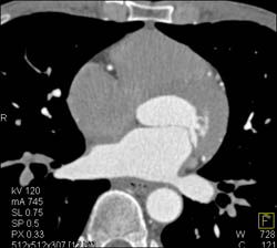 Normal LAD - CTisus CT Scan