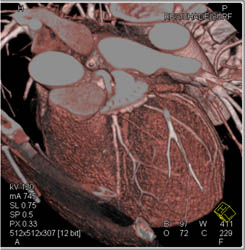 Normal LAD - CTisus CT Scan