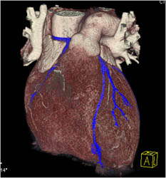 Plaque LAD - CTisus CT Scan