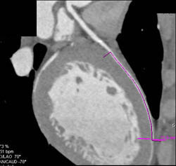 Plaque LAD - CTisus CT Scan