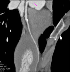 Plaque LAD - CTisus CT Scan