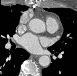 LAD Arises Off Right Cusp - CTisus CT Scan